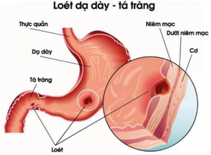 Những triệu chứng bệnh viêm loét dạ dày tá tràng và cách điều trị